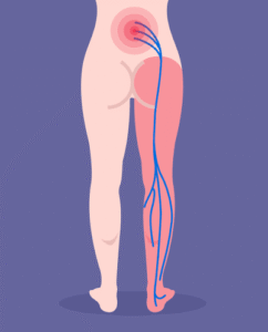 Illustration of low back pain radiating from the lower back through the buttock and down the leg.